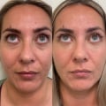 How long do non surgical facelifts last?