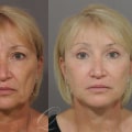 Facelift: A Comprehensive Overview