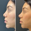 How long does it take for cheek fillers to dissolve?