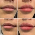 How do you keep fillers from migrating?