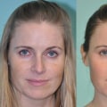 Laser Skin Resurfacing: What You Need to Know