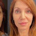 What is the best face lift method?