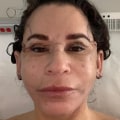 How will i look 3 weeks after a facelift?