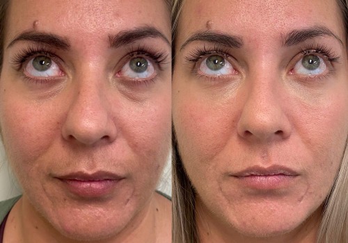 How long do non surgical facelifts last?