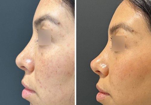 How do you make fillers go away faster?