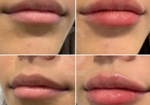 Which fillers are most likely to migrate?