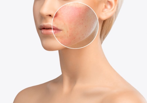 Infection and Scarring: Risks of Laser Skin Resurfacing Treatments