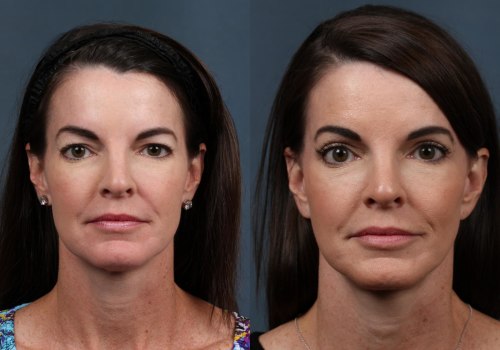 What is the best facelift to have?