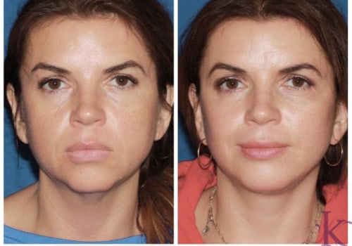 How much does a mini face lift cost in the us?