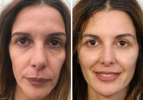 Is a non surgical face lift worth it?