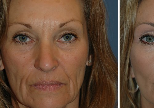 How long does it take for lumps to go away after a facelift?