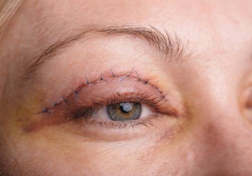Eyelid Surgery: All You Need to Know