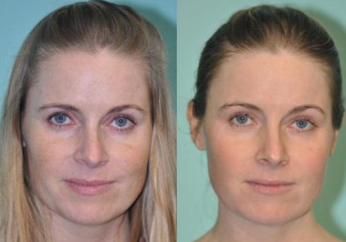 Laser Skin Resurfacing: What You Need to Know