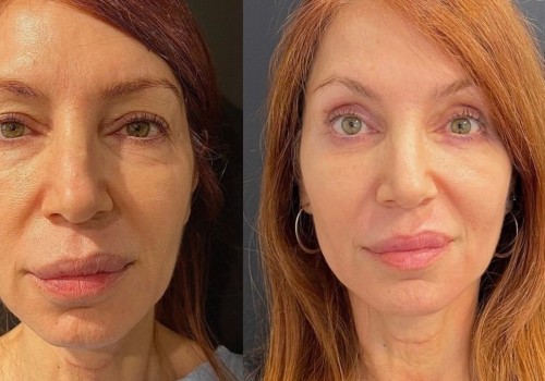 What is the best face lift method?