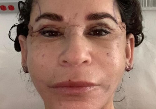 How will i look 3 weeks after a facelift?