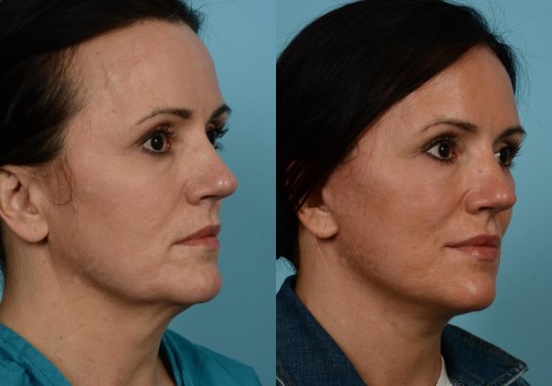 What age to get a mini face lift?